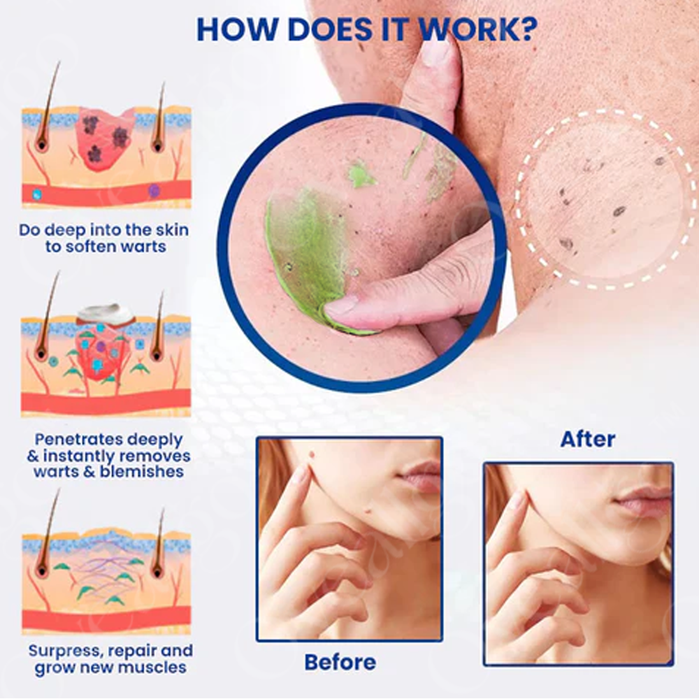 ✅ Official Store: Fivfivgo™ NatureErase Instant Mole & Spot Removal Gel