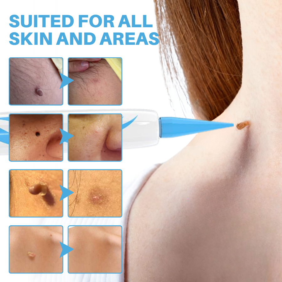Fivfivgo® Painless At-home Skin Tag Removal Pen