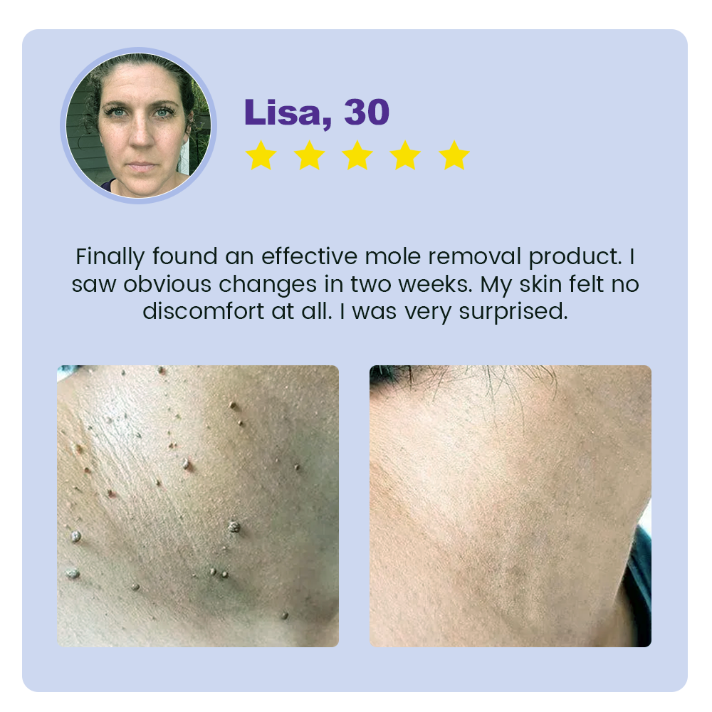 Fivfivgo® Clarivine Dissolver Mole & Dark Spot Removal Bio-Gel