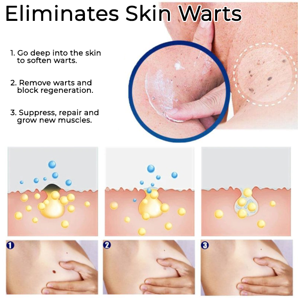 Fivfivgo™ Wart Removal Ointment