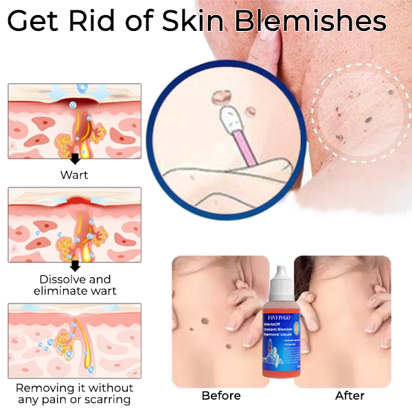 Fivfivgo™ WartsOff Instant Blemish Removal Liquid