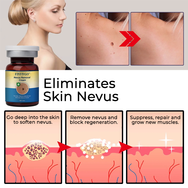 Fivfivgo™ Nevus Removal Cream
