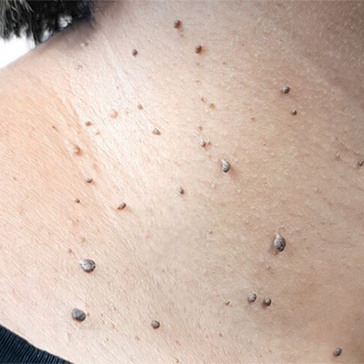 Fivfivgo® Bacteriostatic Black Cumin Skin Tag Remover 20 Fivfivgo® Bacteriostatic Black Cumin Skin Tag Remover