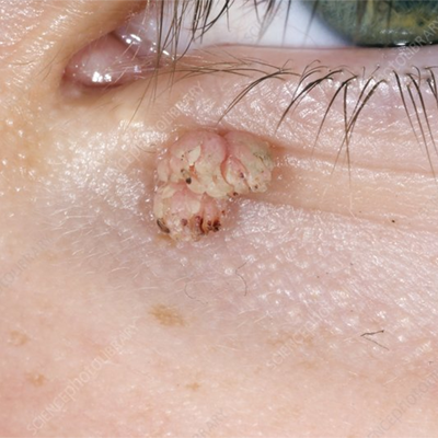 Fivfivgo® Bacteriostatic Black Cumin Skin Tag Remover 21 Fivfivgo® Bacteriostatic Black Cumin Skin Tag Remover