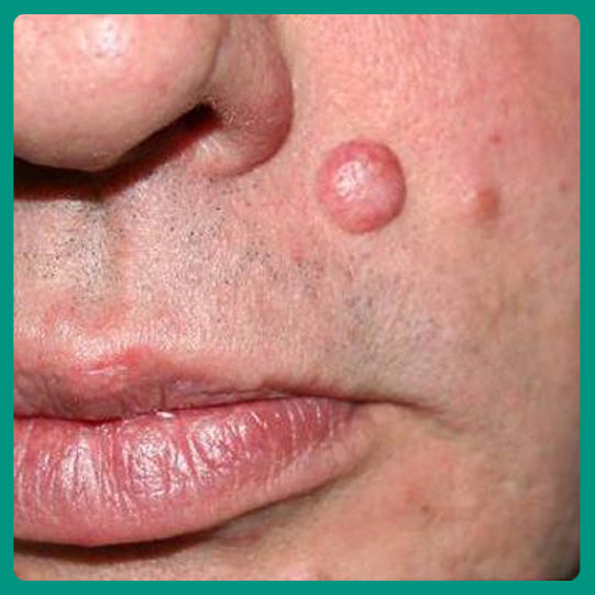 Oveallgo® Magnesium MicroPin Target & Clear Wart Removal Patch 38 Oveallgo® Magnesium MicroPin Target & Clear Wart Removal Patch