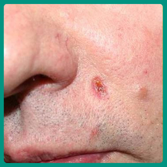 Oveallgo® Magnesium MicroPin Target & Clear Wart Removal Patch 39 Oveallgo® Magnesium MicroPin Target & Clear Wart Removal Patch