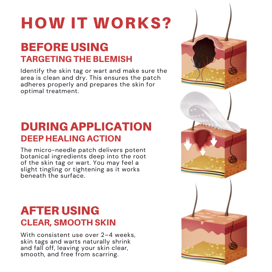 Fivfivgo® MicroNeedle Botanic Skin Tag Removal Patch image Fivfivgo® MicroNeedle Botanic Skin Tag Removal Patch