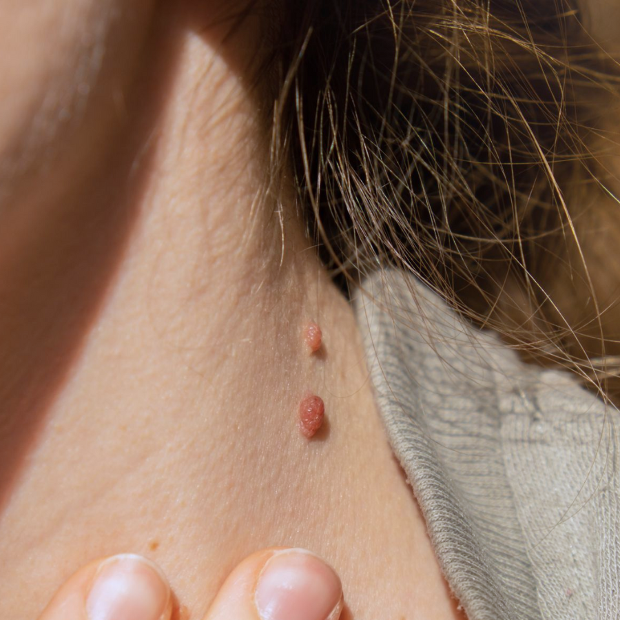 Fivfivgo® MicroNeedle Botanic Skin Tag Removal Patch image Fivfivgo® MicroNeedle Botanic Skin Tag Removal Patch