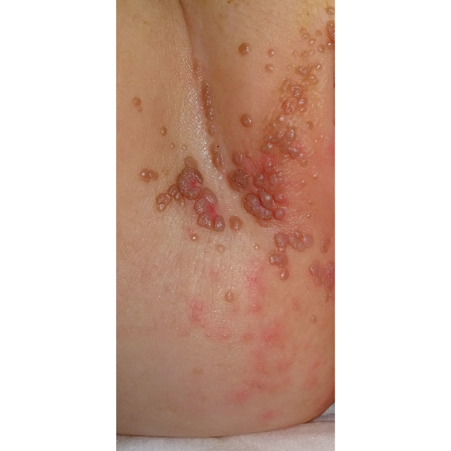 Fivfivgo® Microneedle HPV Genital Warts Removal Patch