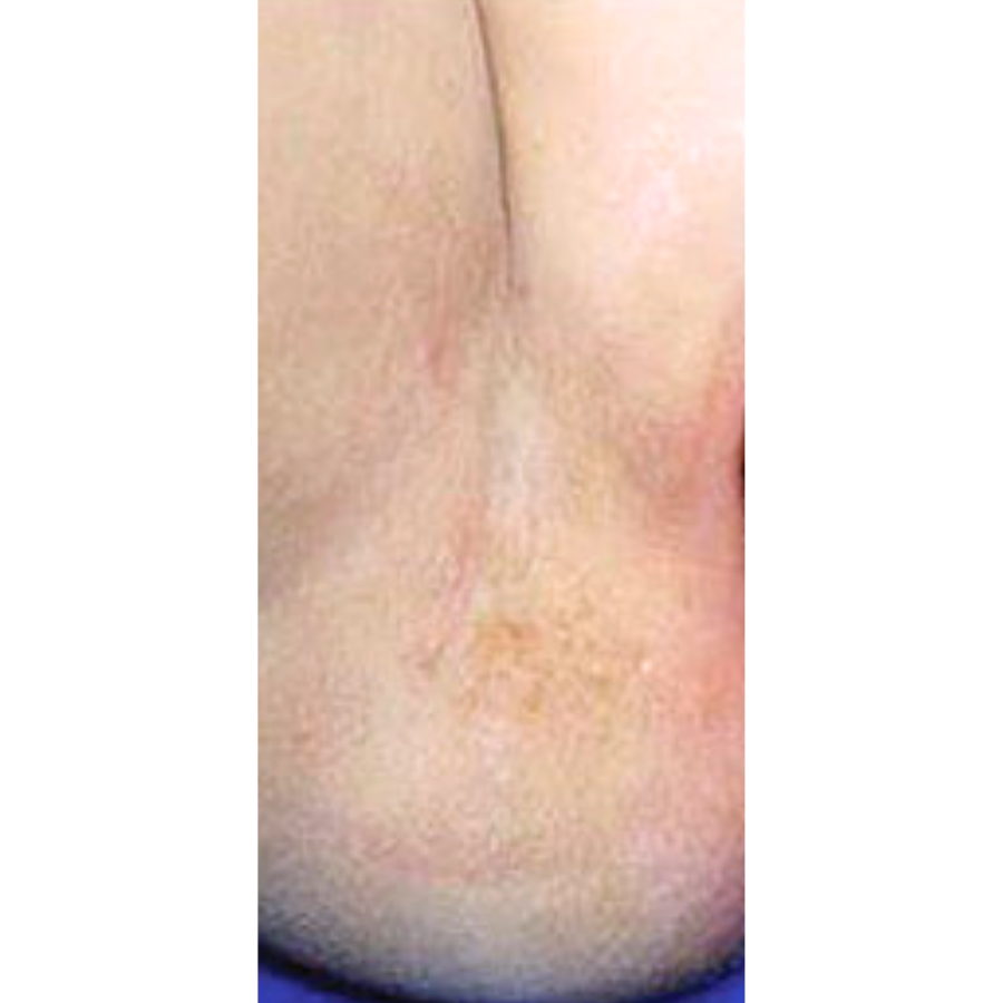 Fivfivgo® Microneedle HPV Genital Warts Removal Patch