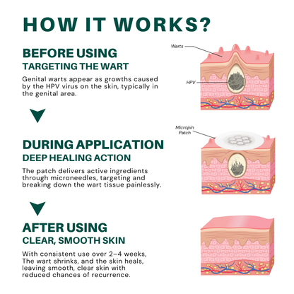 Fivfivgo® Magnesium MicroPin HPV Genital Wart Removal Patch