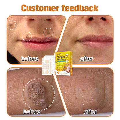 Fivfivgo™ WartGone Bee Venom Treatment Patch (150PCS/PACK)