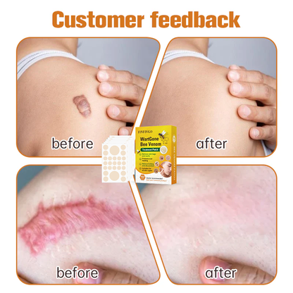 Fivfivgo™ WartGone Bee Venom Treatment Patch (150PCS/PACK)