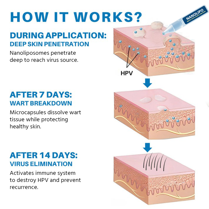 Oveallgo® NANOLIPO GENITAL WARTS CLINICAL AMPOULES image Oveallgo® NANOLIPO GENITAL WARTS CLINICAL AMPOULES