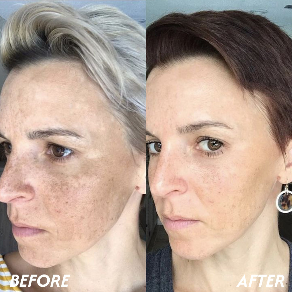 Oveallgo® Korean HerbErase Reedle Shot 100 Black Cumin Seed Oil Dark Spot Peel-Off Facial Mask 16 6 1 2