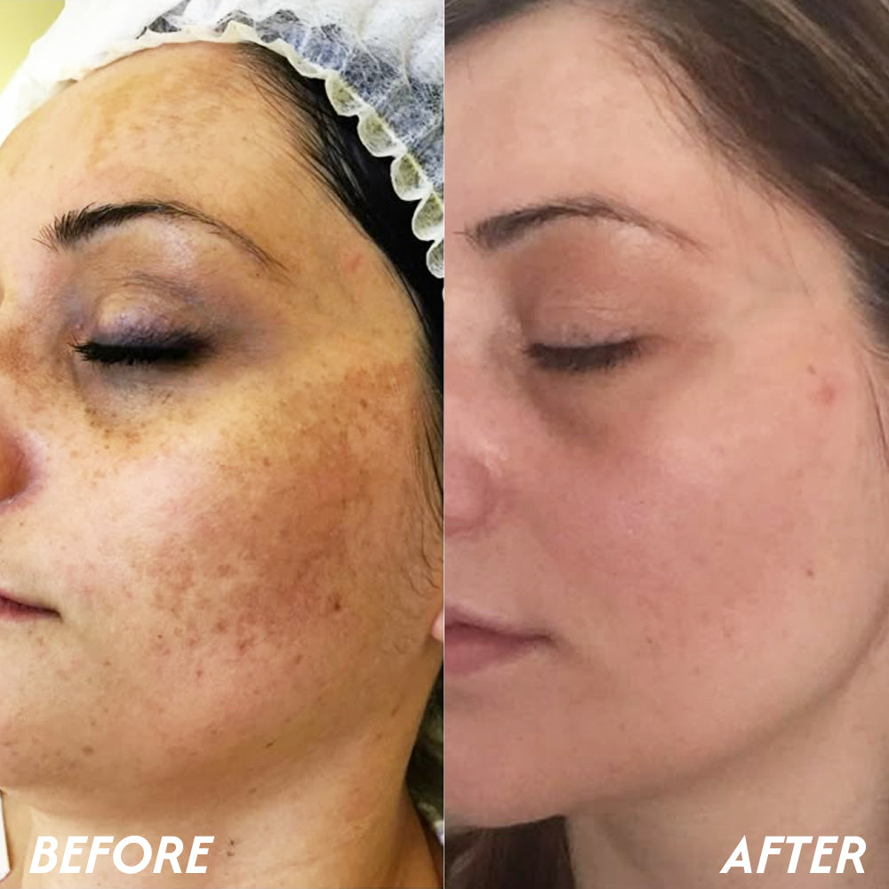 Oveallgo® Korean HerbErase Reedle Shot 100 Black Cumin Seed Oil Dark Spot Peel-Off Facial Mask 13 6 1 e00c2c90 24ce 41cc 9475 0bfeab0e6585