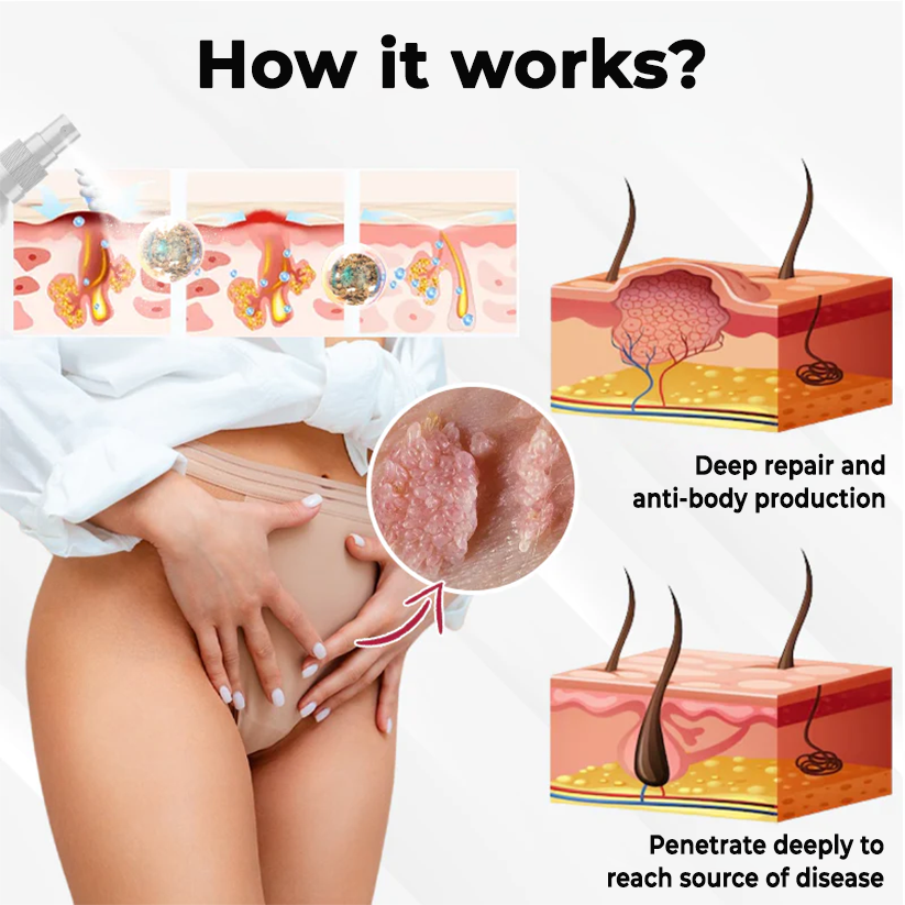 Fivfivgo® Female HPV Genital Wart Caring Spray 24 Fivfivgo® Female HPV Genital Wart Caring Spray