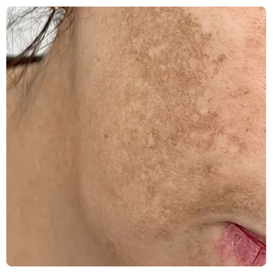 Oveallgo® Korean HerbErase Reedle Shot 100 Black Cumin Seed Oil Dark Spot Peel-Off Facial Mask 23 7 2 58005880 252b 4bc7 99df eba9996bc26c