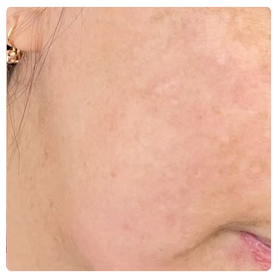 Oveallgo® Korean HerbErase Reedle Shot 100 Black Cumin Seed Oil Dark Spot Peel-Off Facial Mask 24 7 3 ed55bb41 76f6 4ac5 99df cbbac2594eea