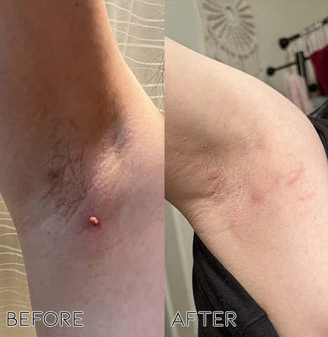 Fivfivgo® Bacteriostatic Black Cumin Skin Tag Remover 22 A dbb03fe6 521d 4f0f aa32 c52df3a01a41