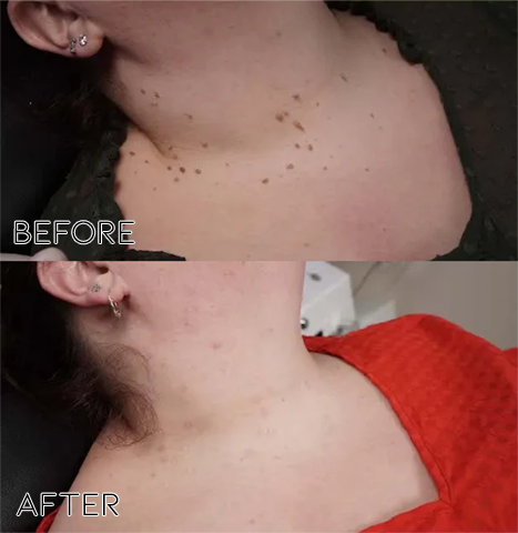 Fivfivgo® Bacteriostatic Black Cumin Skin Tag Remover 23 B 2756a231 b790 4a63 a765 4db693e4b3be