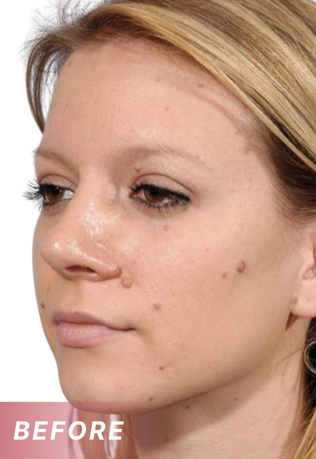 Fivfivgo® Tags & Blemish Peel-Off Wrapping Mask 20 Before 6bb9cbce 60f9 407d aab6 b63f95eaf14c