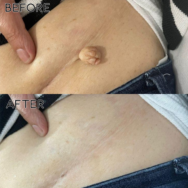 Fivfivgo® Bacteriostatic Black Cumin Skin Tag Remover 25 C 7876f8f3 2af9 4238 abde ba57074fd25d