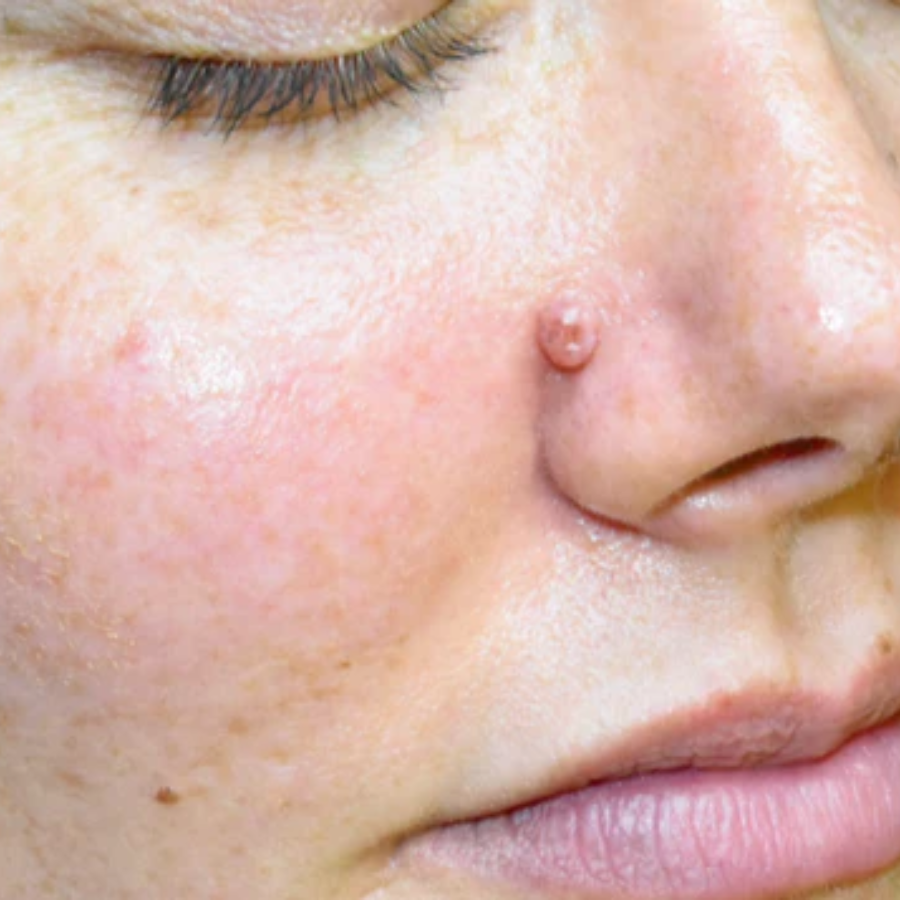 Oveallgo® NanoLipo HPV Genital Warts Eraser Cream 22 DAY 1