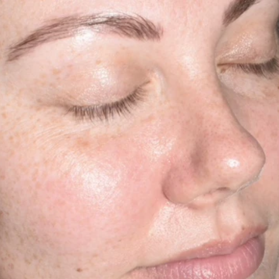 Oveallgo® NanoLipo HPV Genital Warts Eraser Cream 24 DAY 14