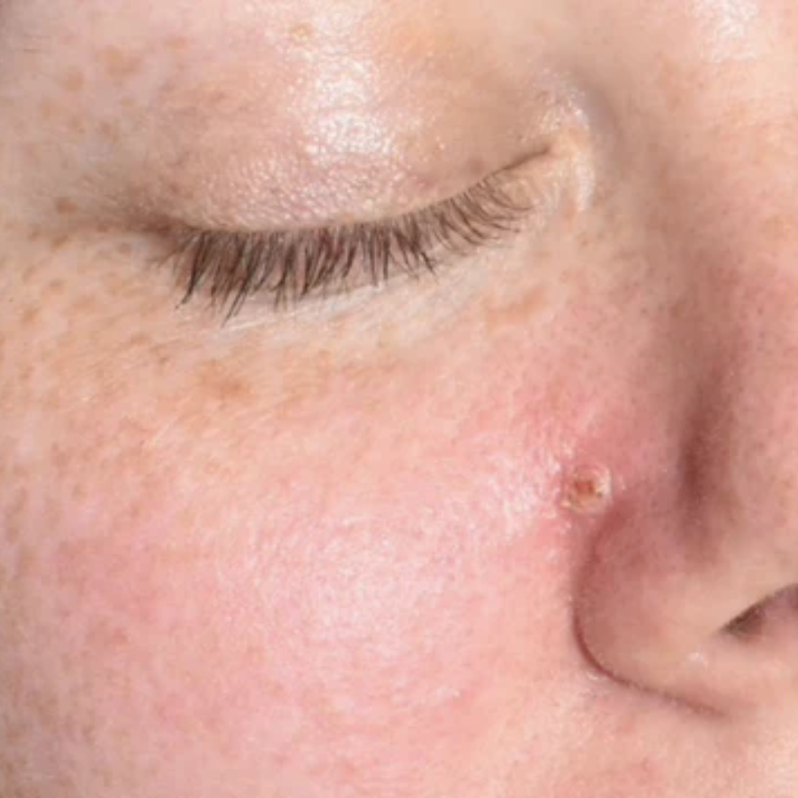 Oveallgo® NanoLipo HPV Genital Warts Eraser Cream 23 DAY 7