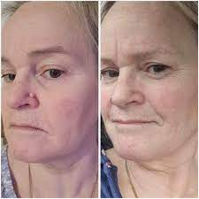 Fivfivgo® Bacteriostatic Black Cumin Skin Tag Remover 26 D f8c40901 9467 4b02 b54d 559e93877f90