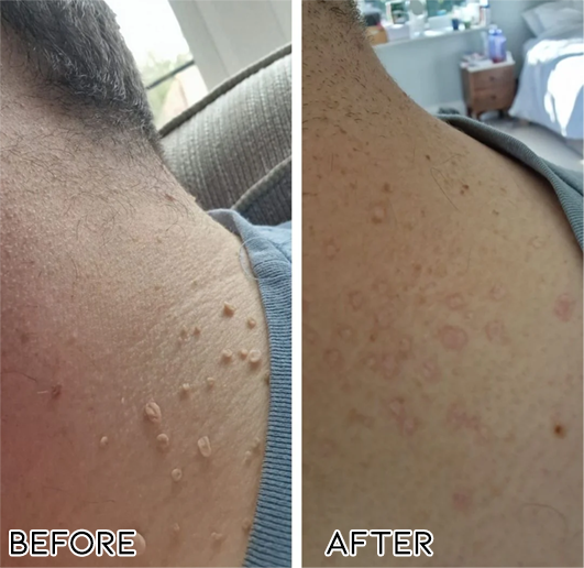 Fivfivgo® Bacteriostatic Black Cumin Skin Tag Remover 24 E c4ba43a2 5903 4eed b181 c4b5860a3750