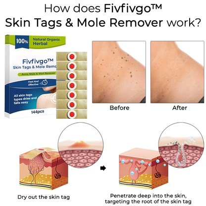 Fivfivgo™ Skin Tags & Mole Remover