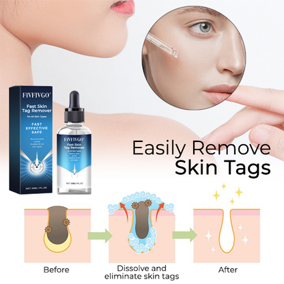 Fivfivgo® Fast Skin Tag Remover for All Skin Types