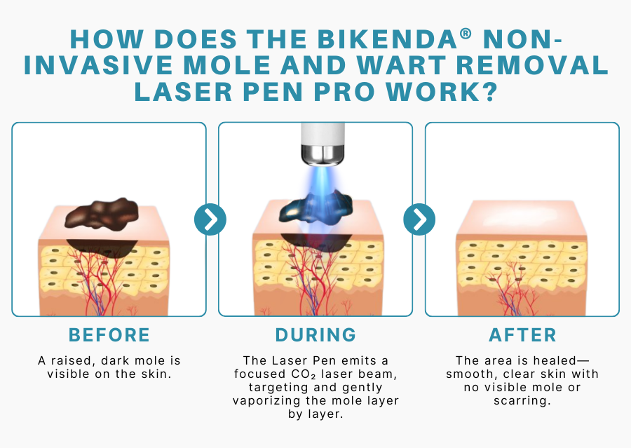 Bikenda® Non-Invasive Mole and Wart Removal Laser Pen 26 Bikenda® Non-Invasive Mole and Wart Removal Laser Pen