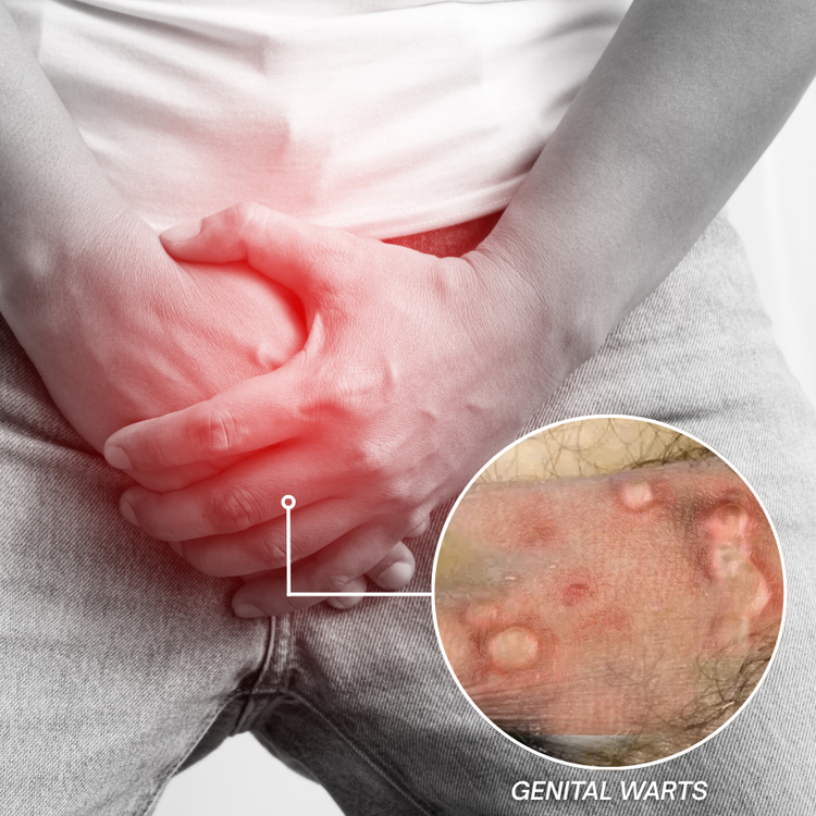 Genital Wart Symptom Infographic