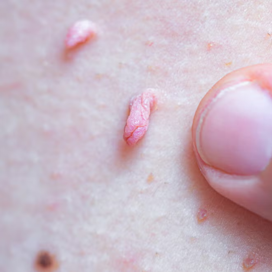 Bikenda® Non-Invasive Mole and Wart Removal Laser Pen 23 Bikenda® Non-Invasive Mole and Wart Removal Laser Pen