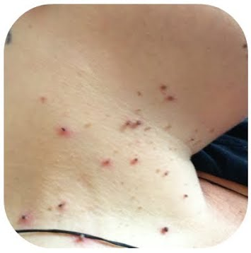 Fivfivgo® Bacteriostatic Black Cumin Skin Tag Remover 34 Stage 1 3890ea54 8b6b 41a8 857e 5bcfbf3ae0b9