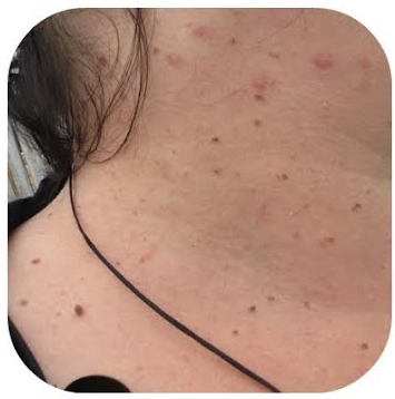 Fivfivgo® Bacteriostatic Black Cumin Skin Tag Remover 35 Stage 2 f22b786a 58f3 4312 915e 0e65cc921bed