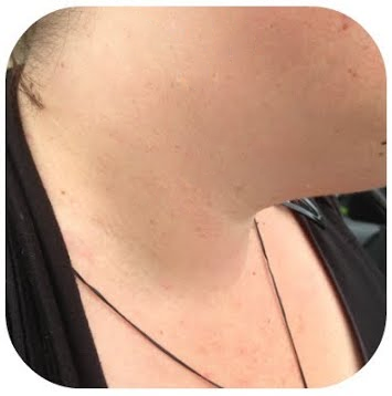 Fivfivgo® Bacteriostatic Black Cumin Skin Tag Remover 36 Stage 3 38817f6e e6fe 4fac b343 29d491d8743f