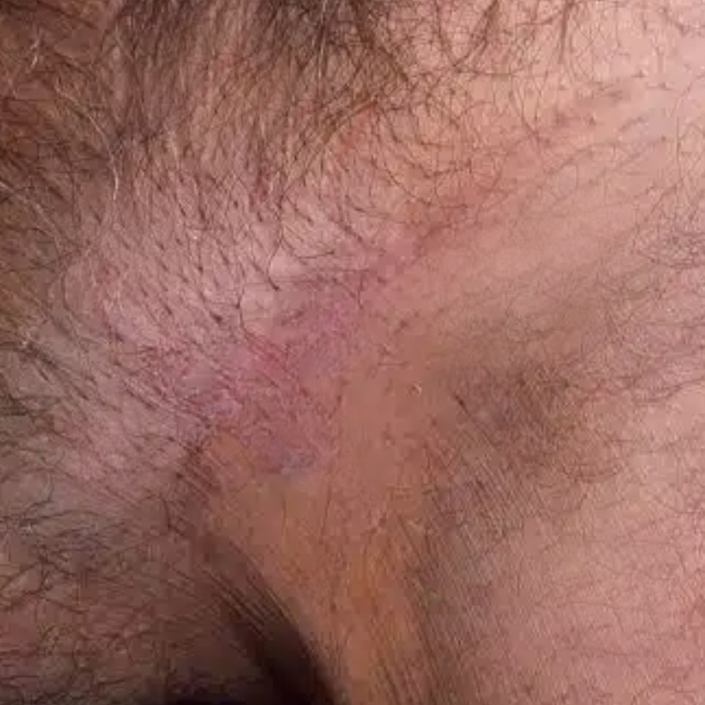 Oveallgo® HPV Genital Warts Relief Cream 29 Oveallgo® HPV Genital Warts Relief Cream