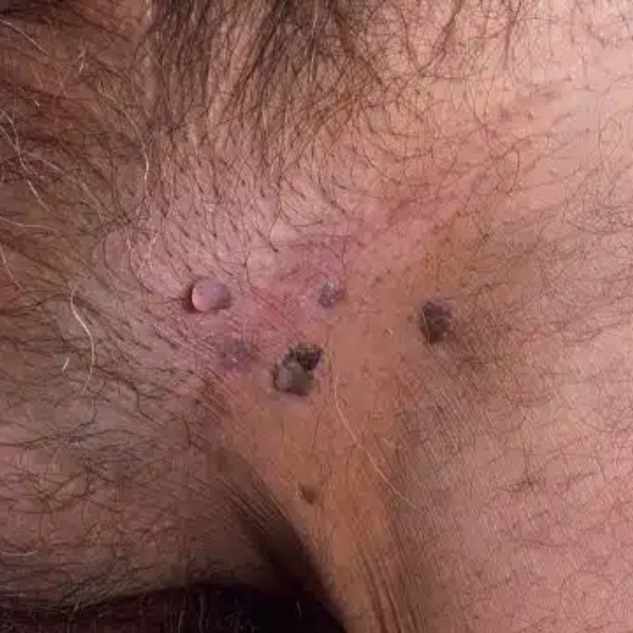 Oveallgo® HPV Genital Warts Relief Cream 27 Oveallgo® HPV Genital Warts Relief Cream