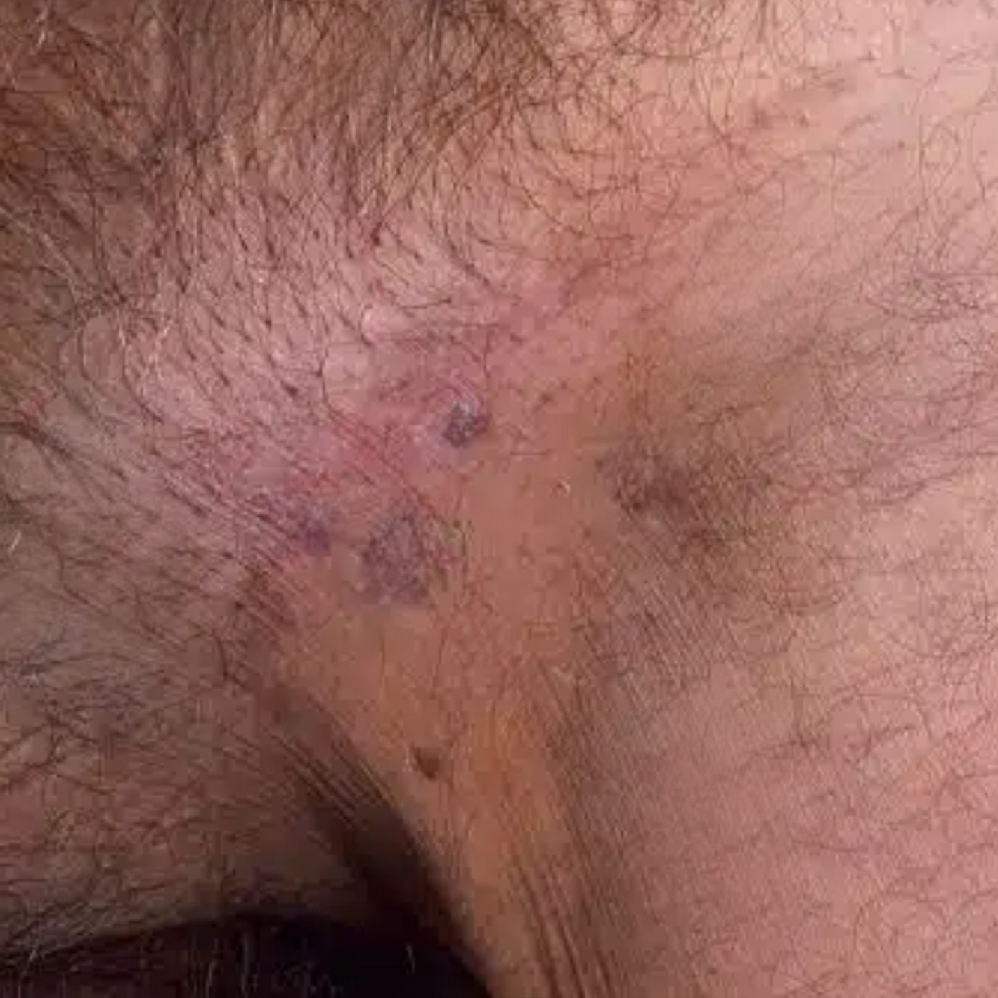 Oveallgo® HPV Genital Warts Relief Cream 28 Oveallgo® HPV Genital Warts Relief Cream