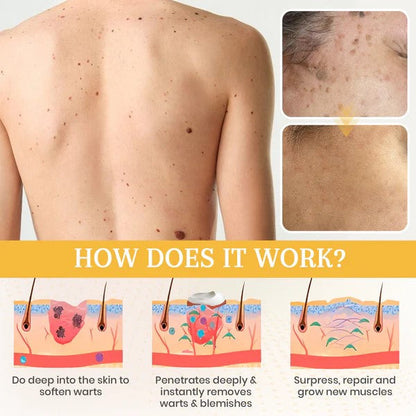 Fivfivgo® DermaErase Advanced Mole & Spot Removal Gel